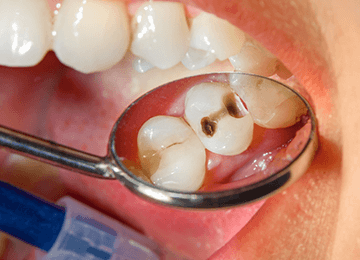 Cavity Treatment Ottawa ON