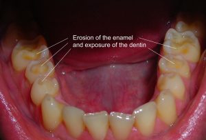 Enamel Erosion 1