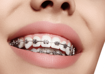 Braces On Crooked Teeth Ottawa ON