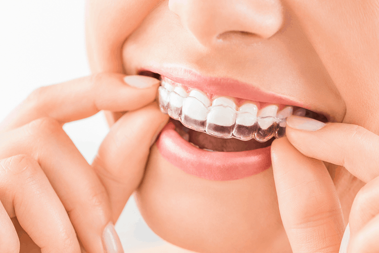 Invisalign Teeth Treatment Ottawa ON