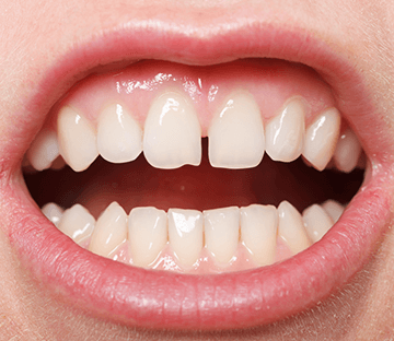 Gap Between Teeth Treatment Ottawa ON