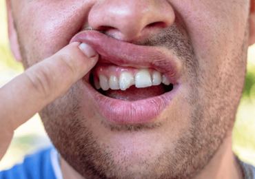 Dentist Chipped Tooth Ottawa ON