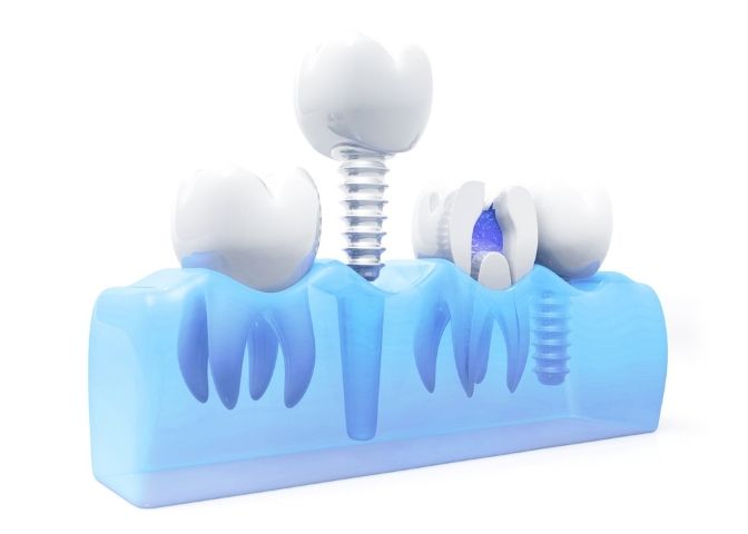 Dental implant