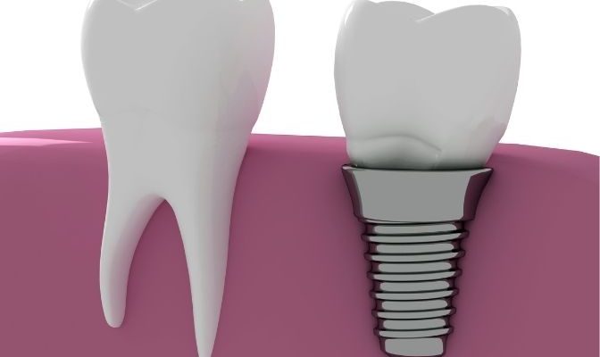 Dental implant