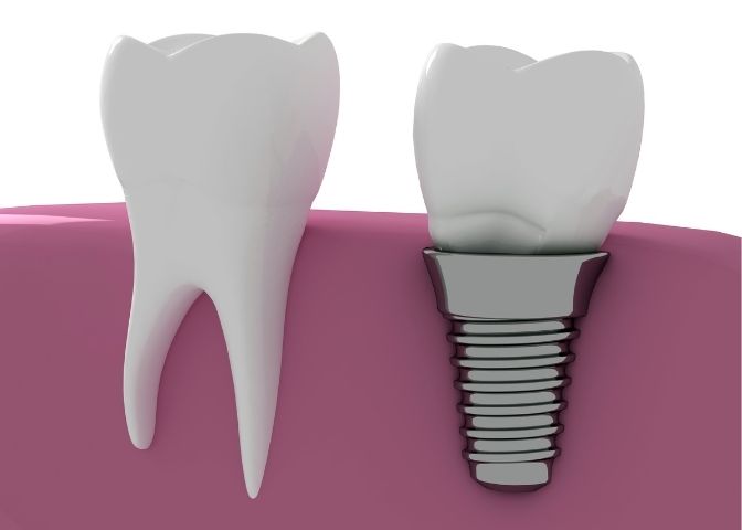 Dental implant