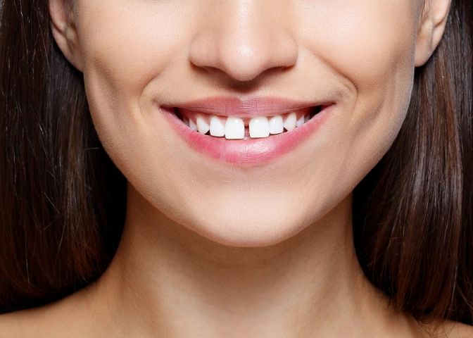 The young woman's with teeth gap